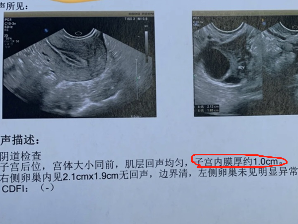 <b>内膜厚24mm没来月经不是怀孕，对比这三种情况治疗是关键</b>